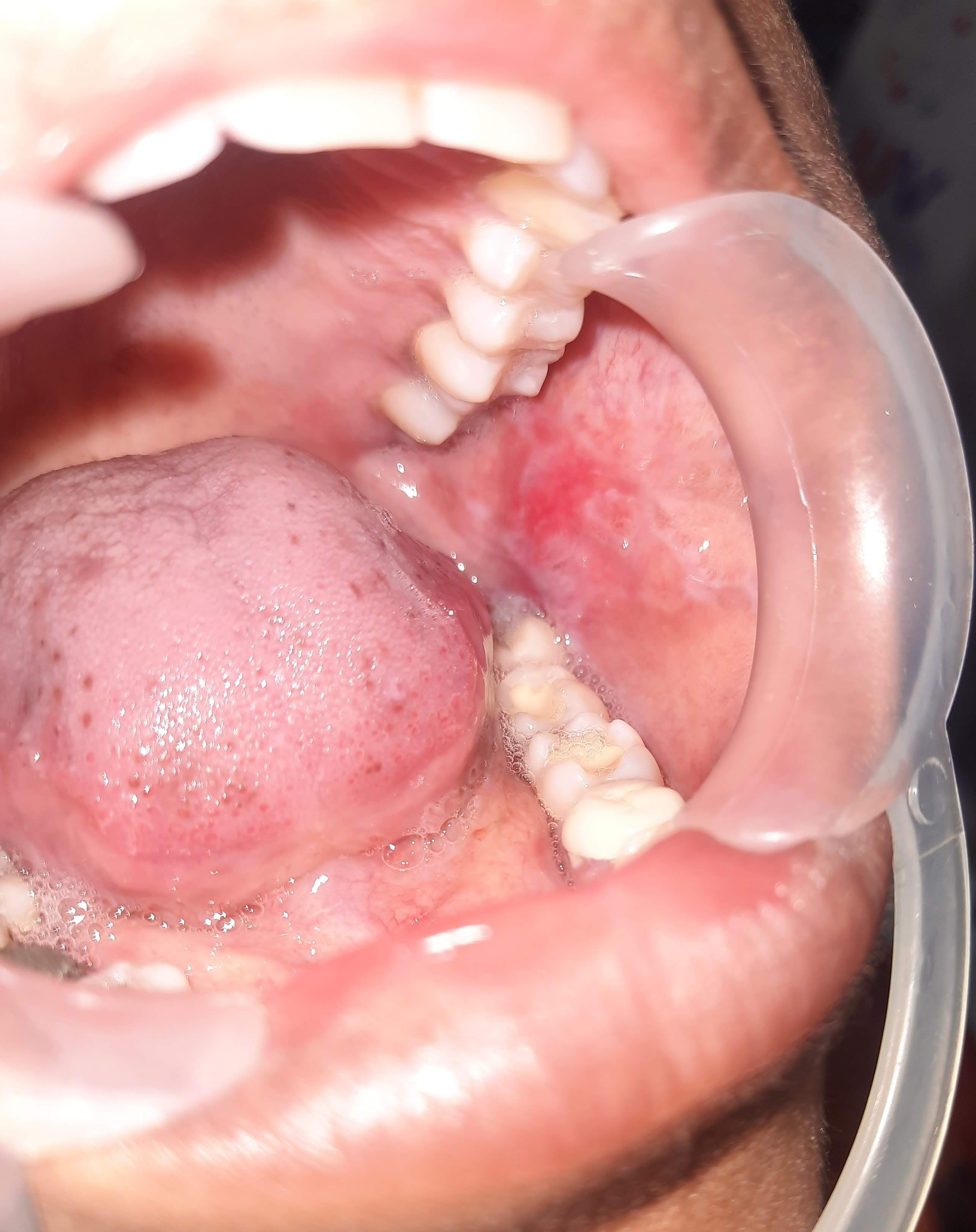 Oral Lichen Planus case